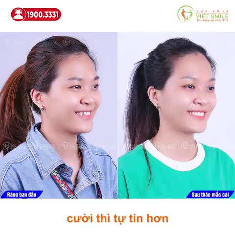 THÁO NIỀNG RĂNG CHEN CHÚC, MỌC VẾCH CHỈ SAU 1 NĂM